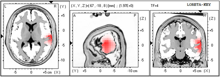 Second recording LORETA at 4 Hz showing right temporal excess